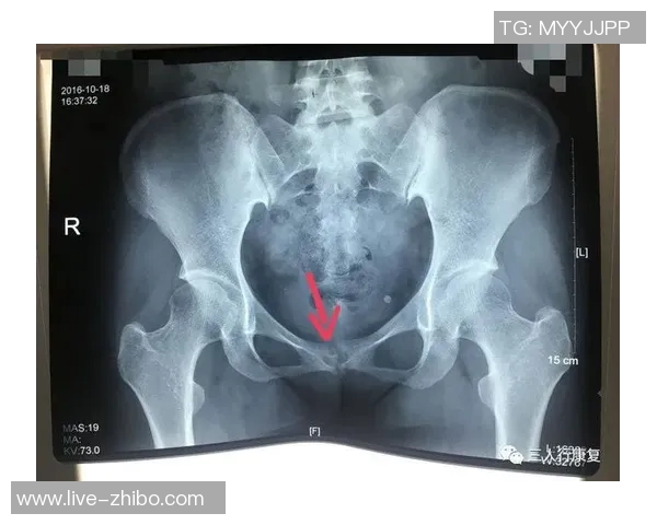 尼科威廉姆斯谈耻骨炎恢复过程并表示需带伤出战的挑战与决心